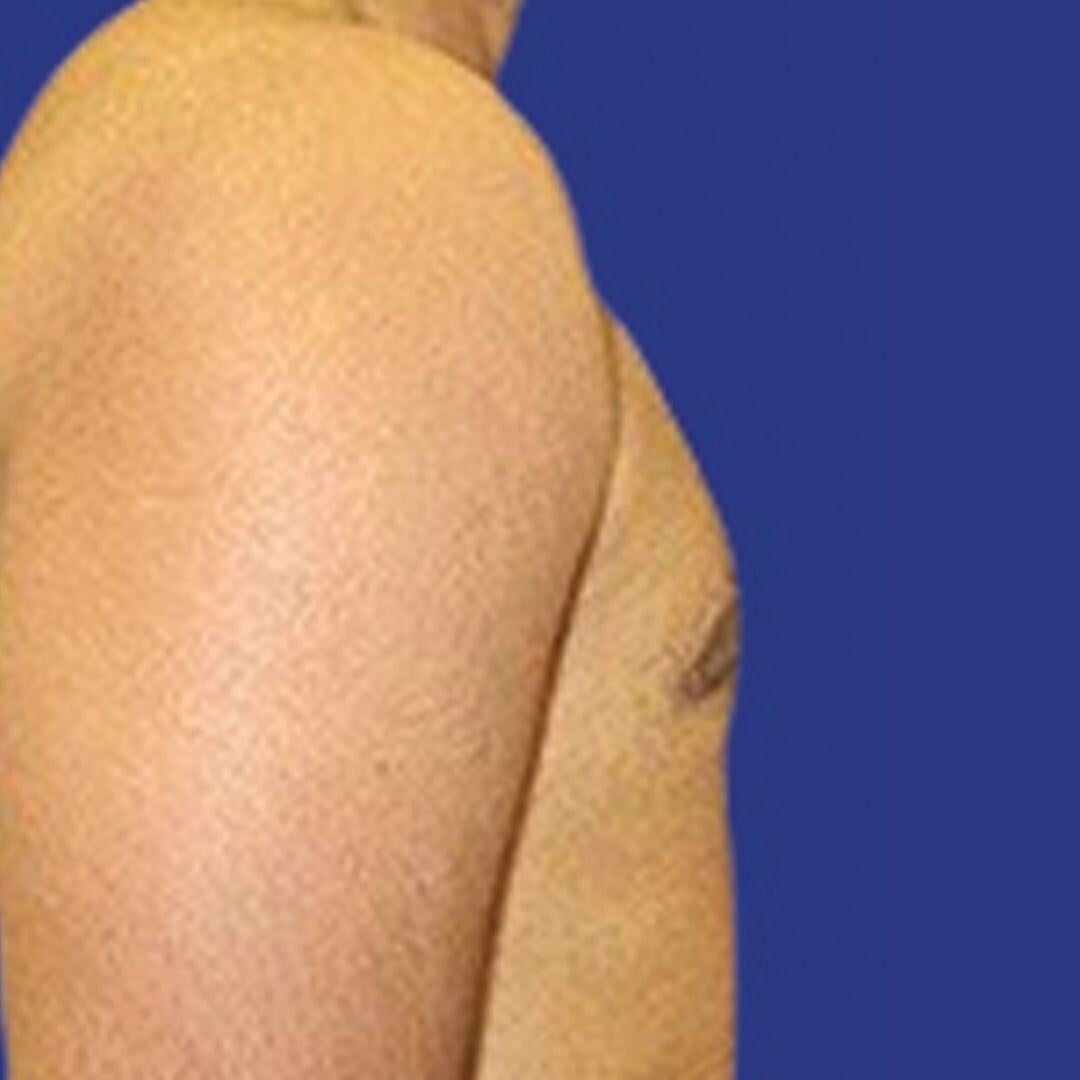 Procedure before and after - after
