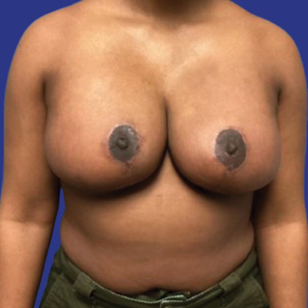 Procedure before and after - after