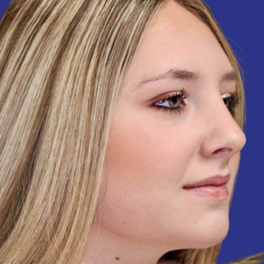 Procedure before and after - after