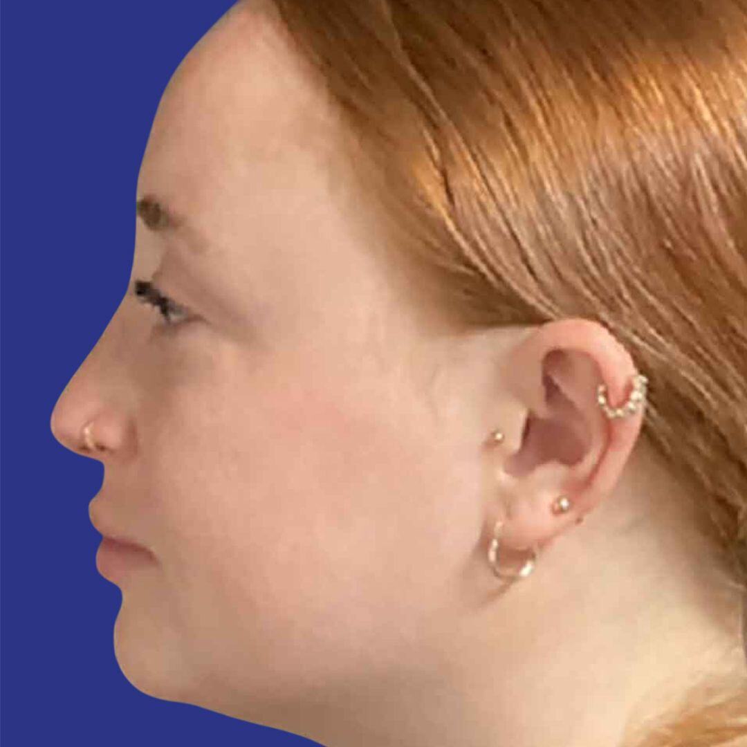 Procedure before and after - after