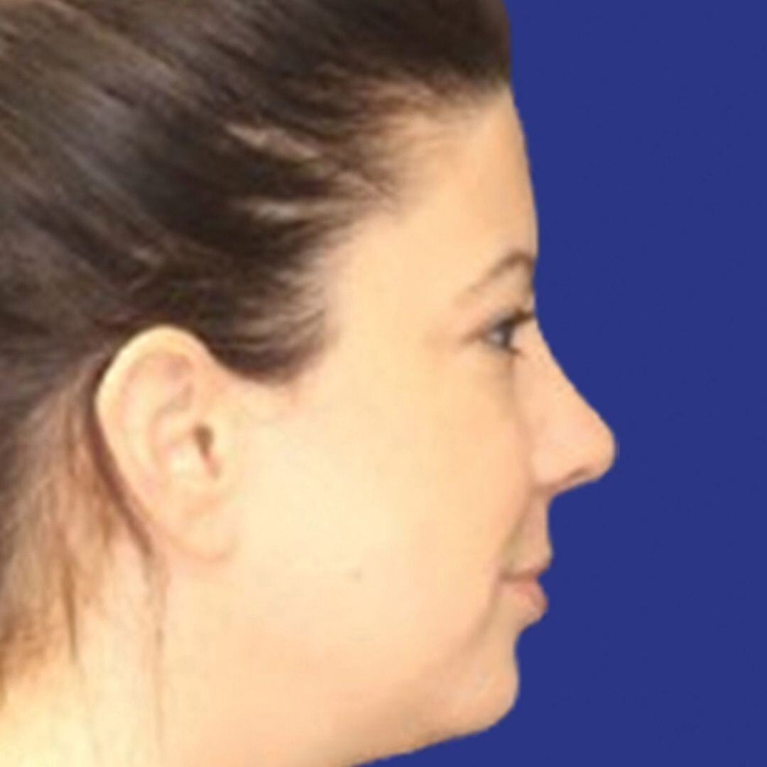 Procedure before and after - after
