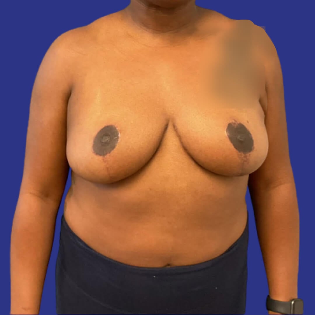 Procedure before and after - after