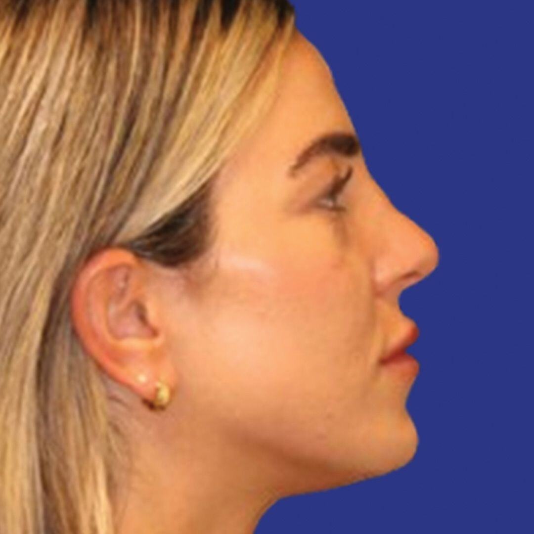 Procedure before and after - after