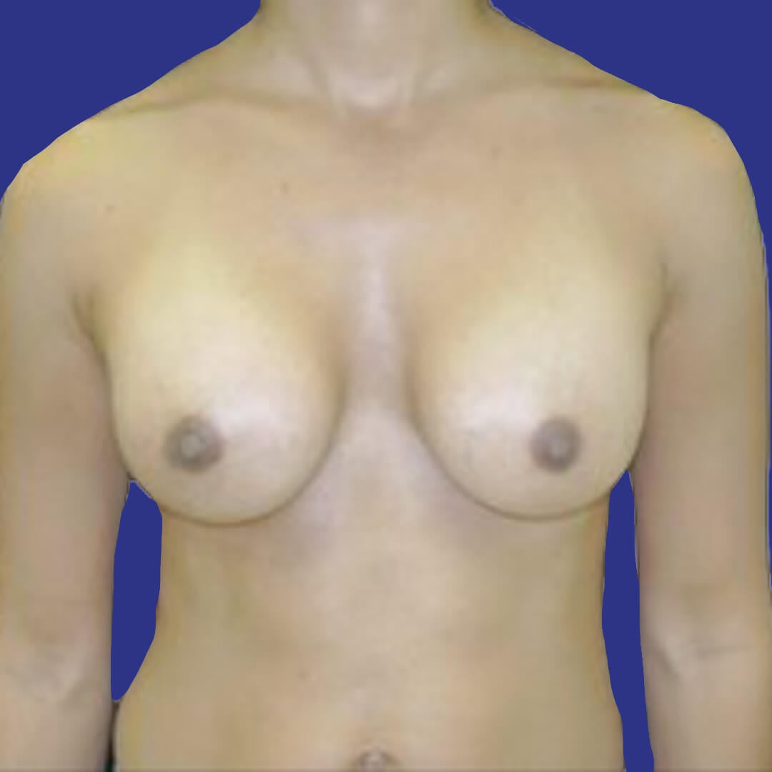 Procedure before and after - after