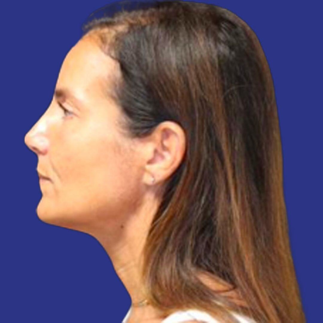 Procedure before and after - after