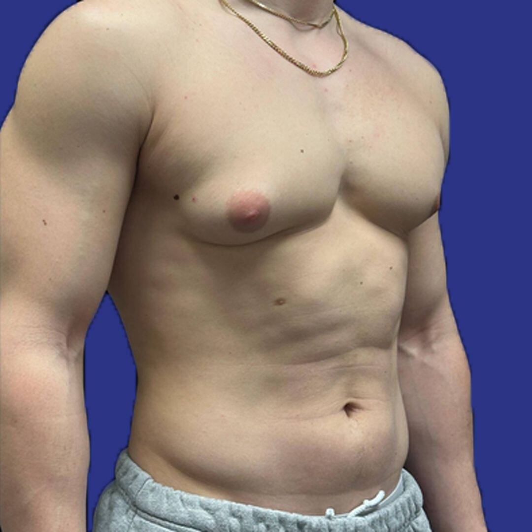 Procedure before and after - before