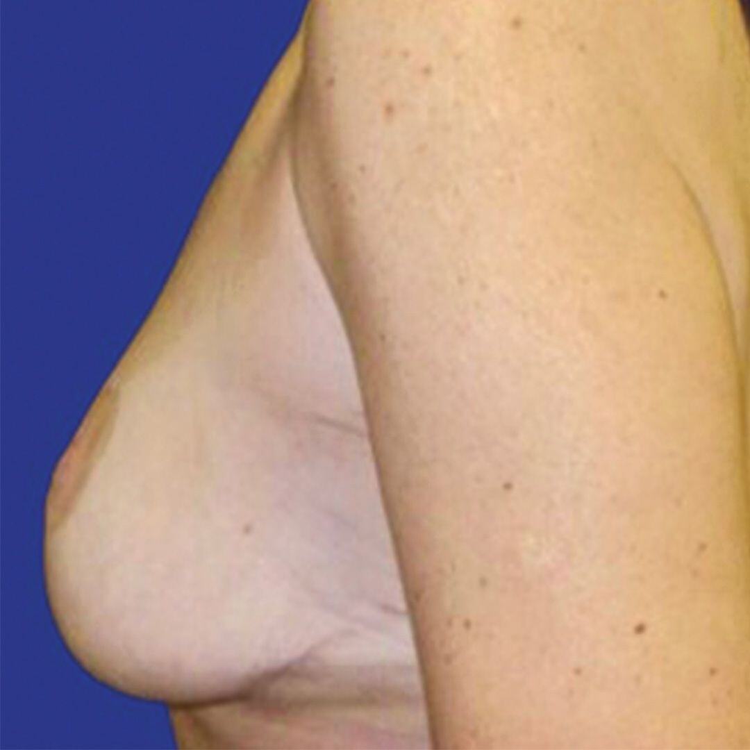 Procedure before and after - before