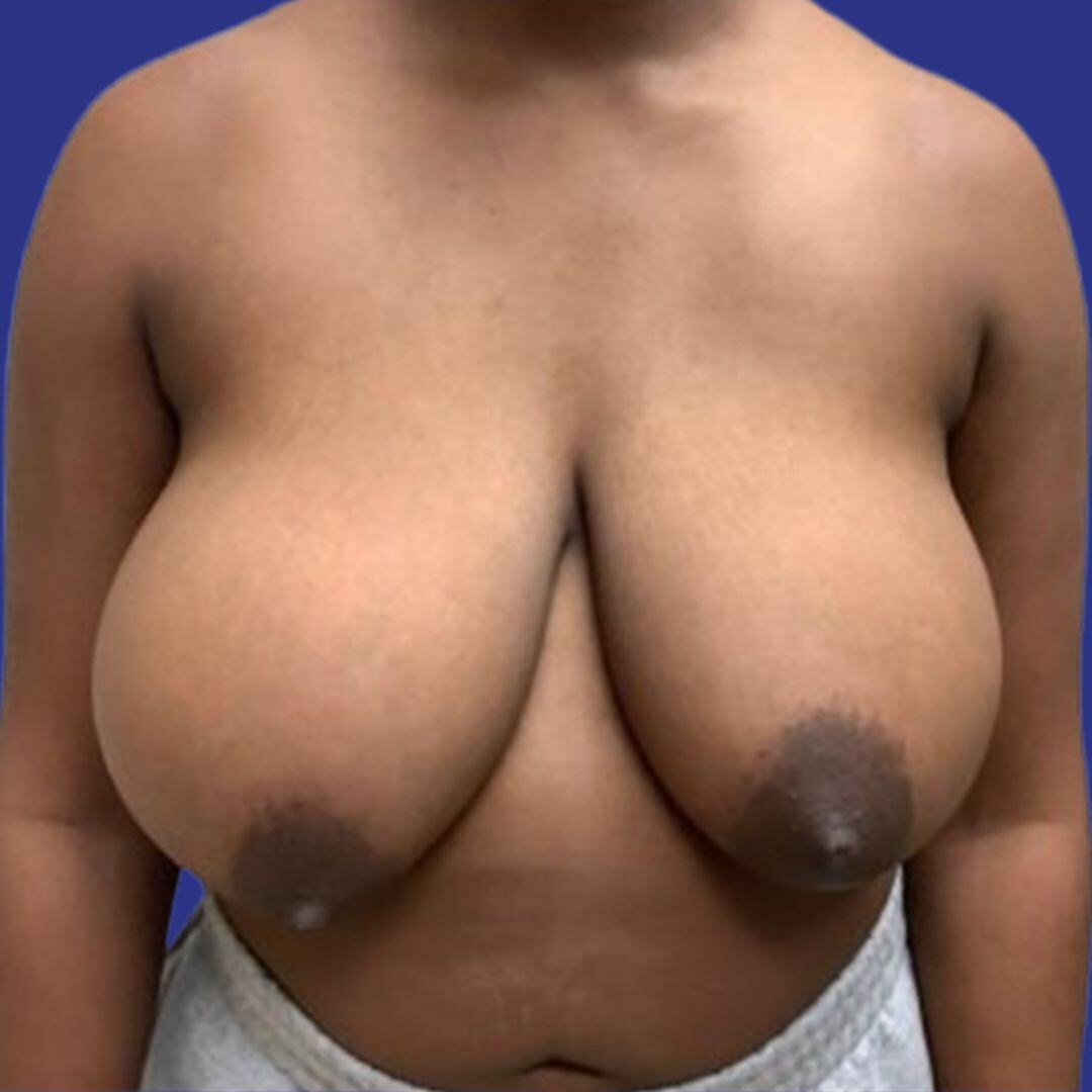 Procedure before and after - before