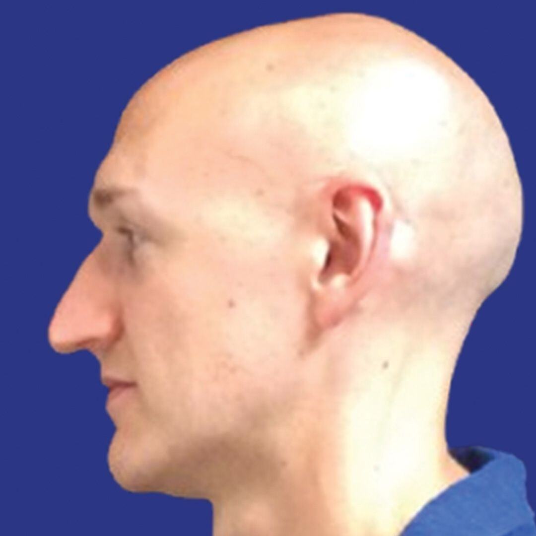 Procedure before and after - before
