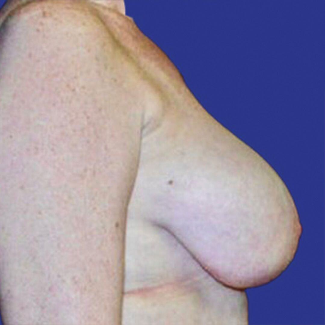 Procedure before and after - before