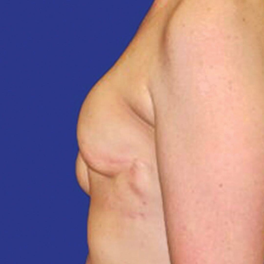 Procedure before and after - before