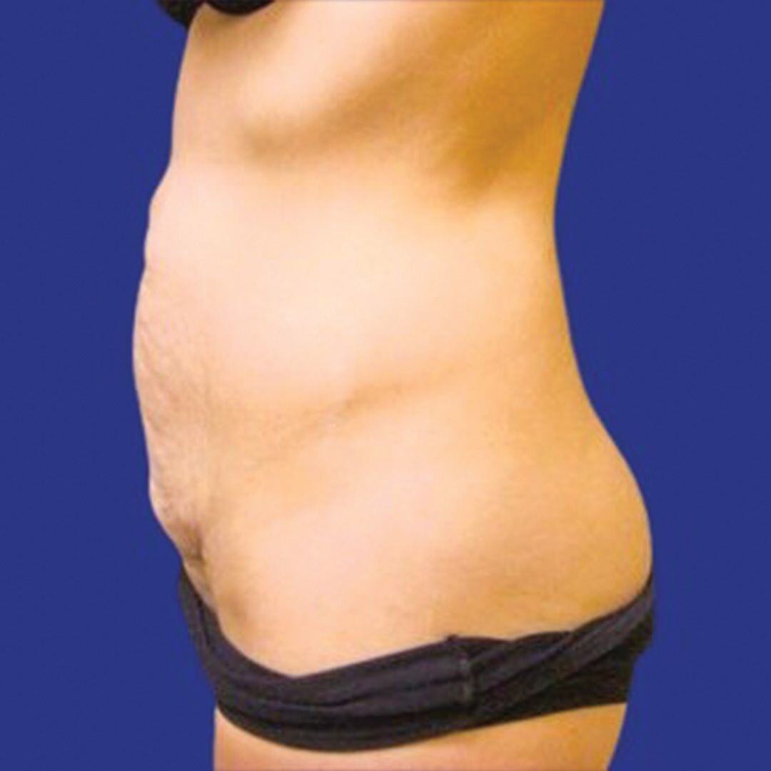 Procedure before and after - before