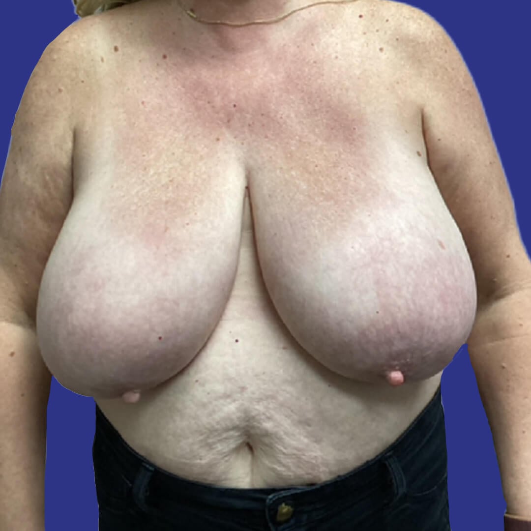 Procedure before and after - before