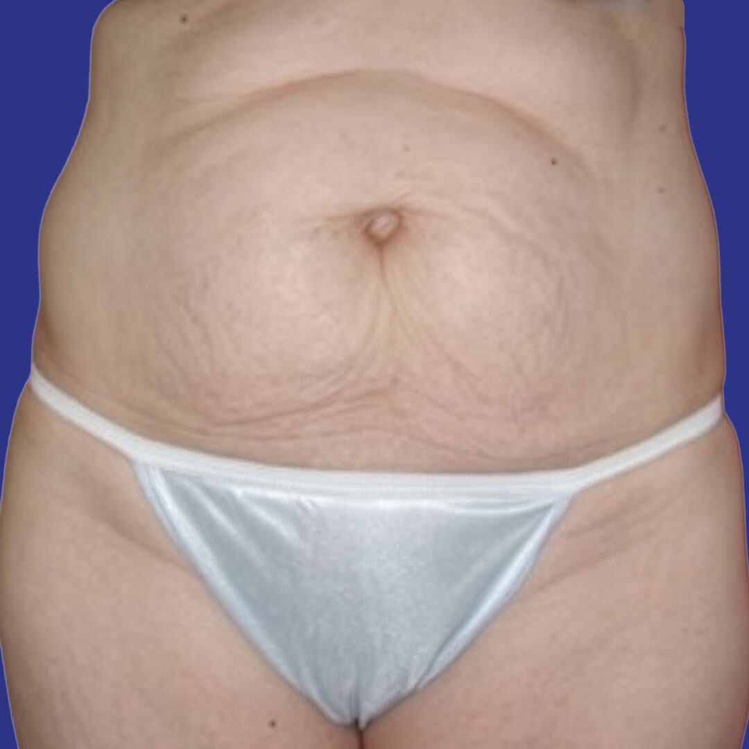 Procedure before and after - before
