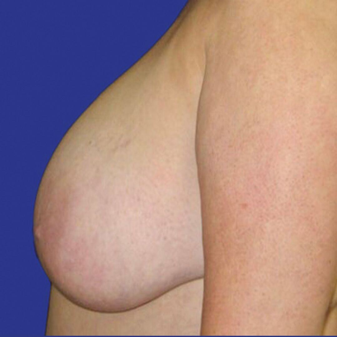 Procedure before and after - before