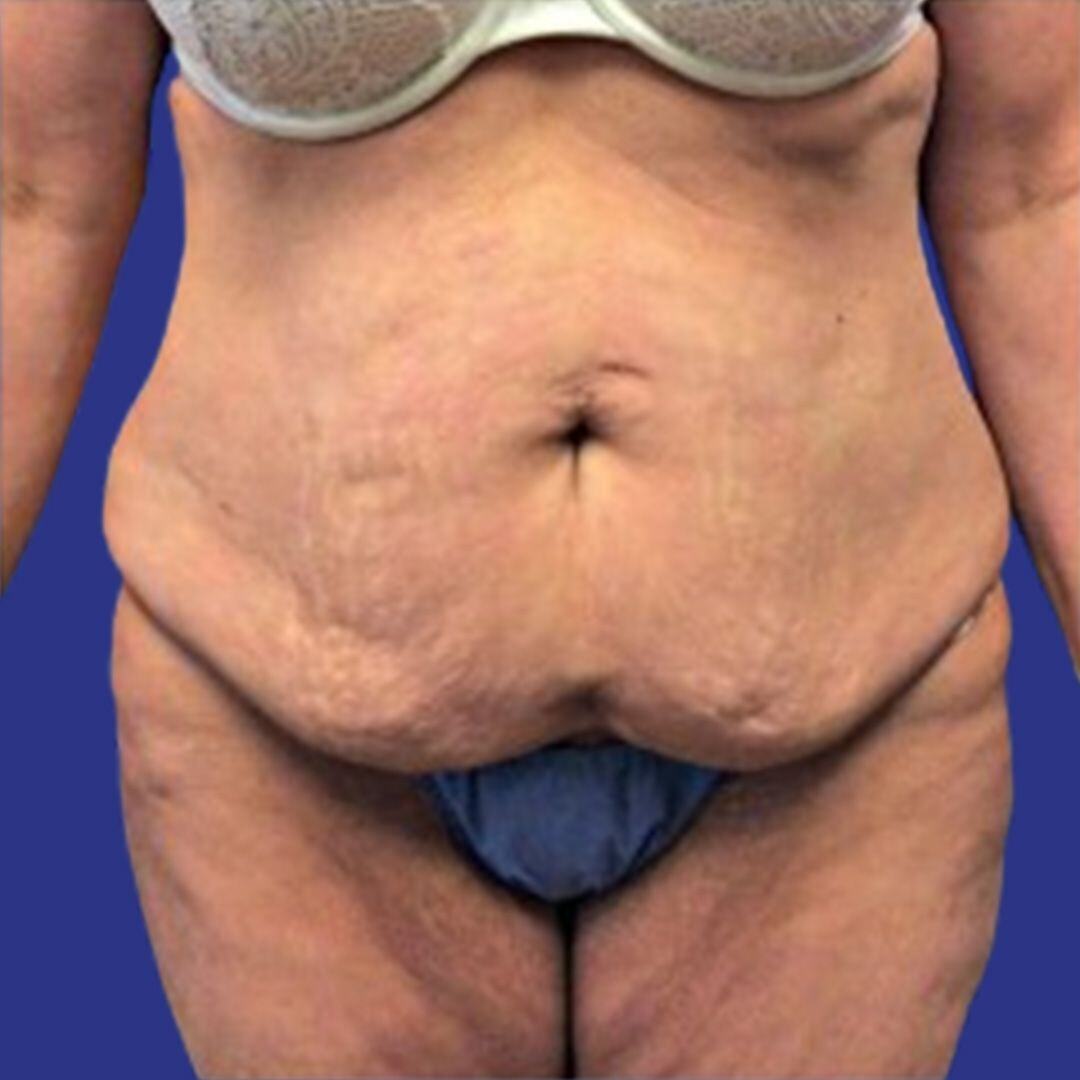 Procedure before and after - before