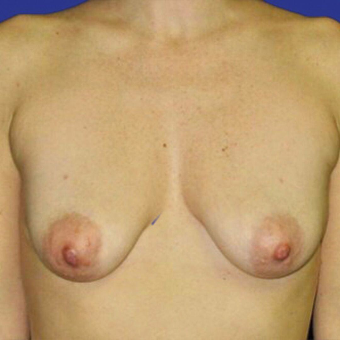 Procedure before and after - before