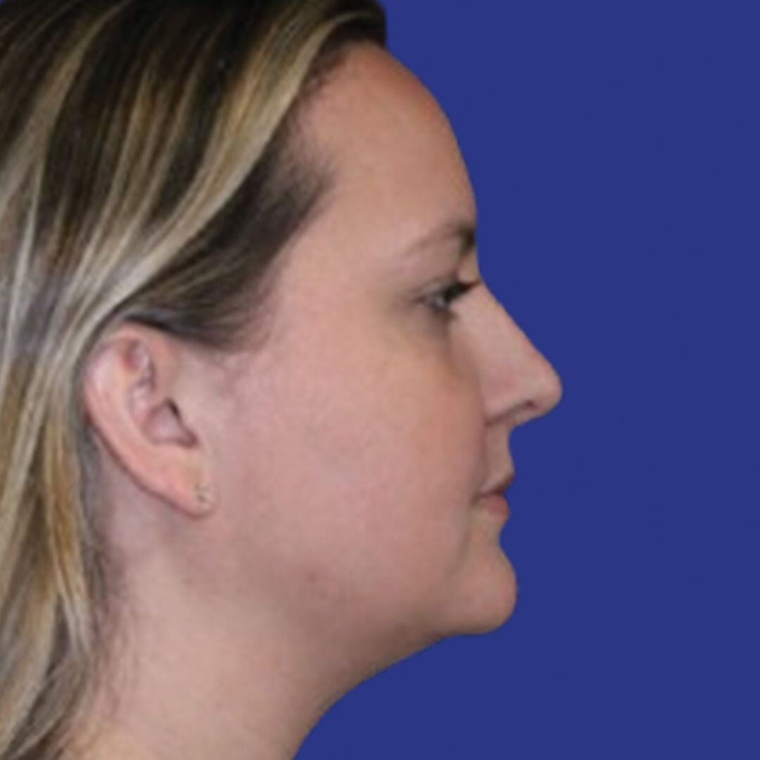 Procedure before and after - before