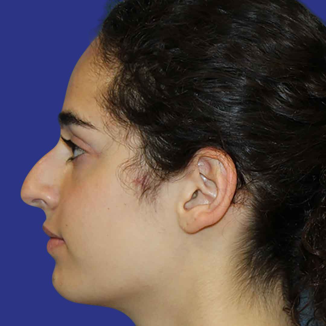 Procedure before and after - before