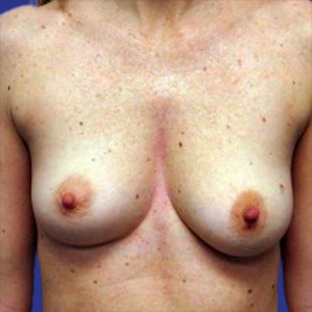 Procedure before and after - before