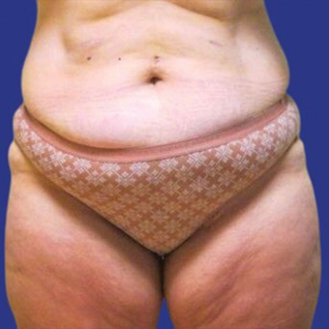 Procedure before and after - before