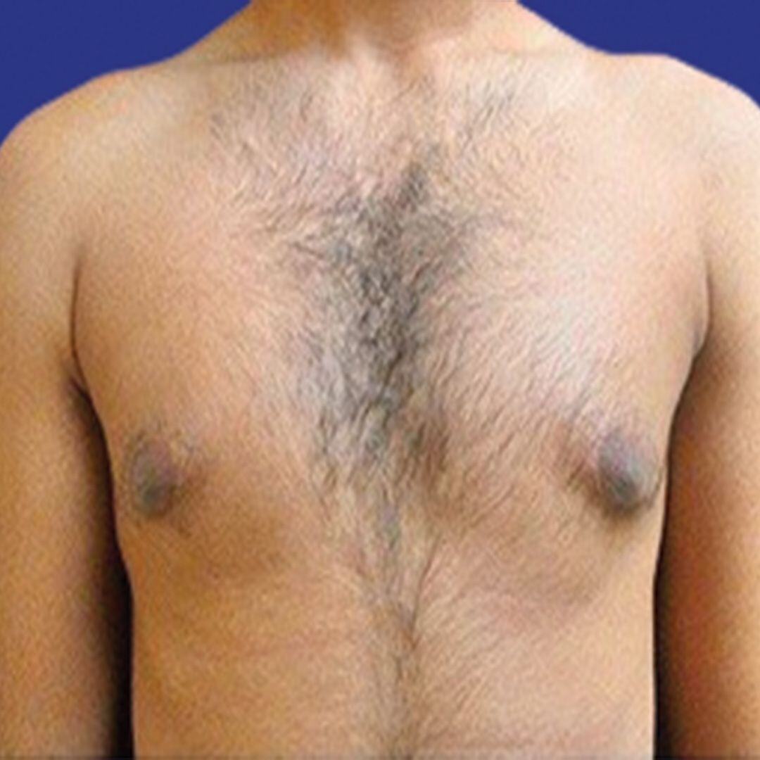 Procedure before and after - before