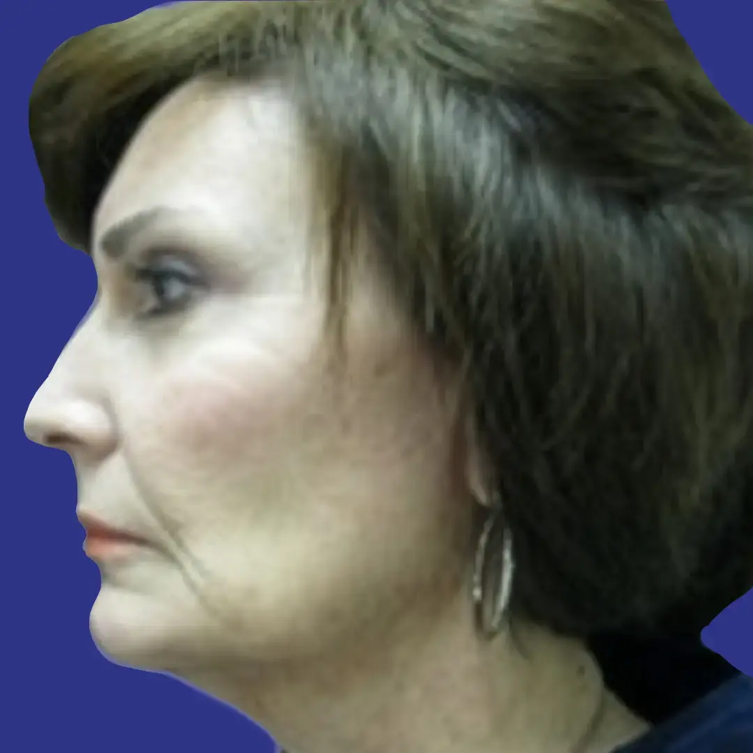 Procedure before and after - before