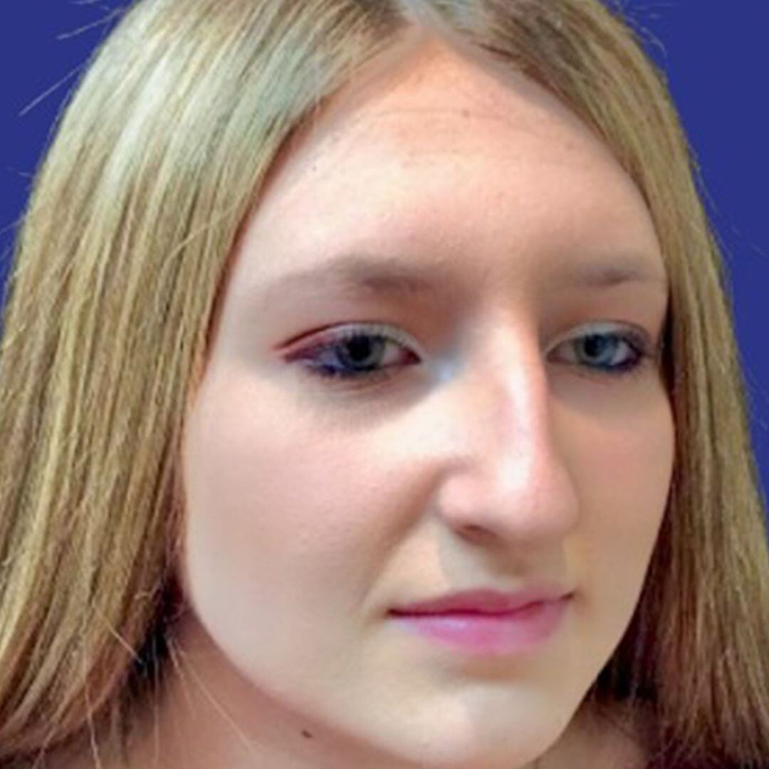 Procedure before and after - before