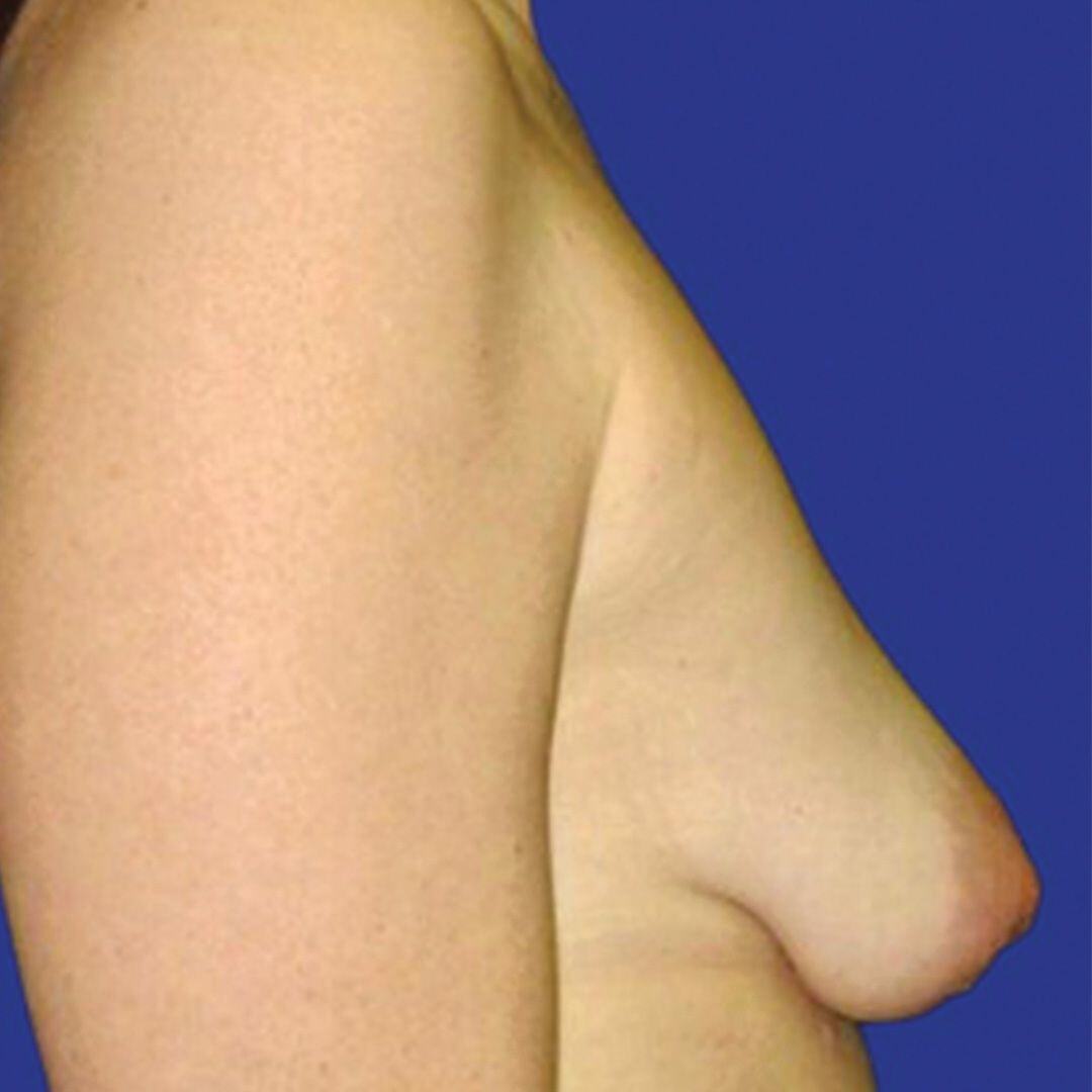 Procedure before and after - before