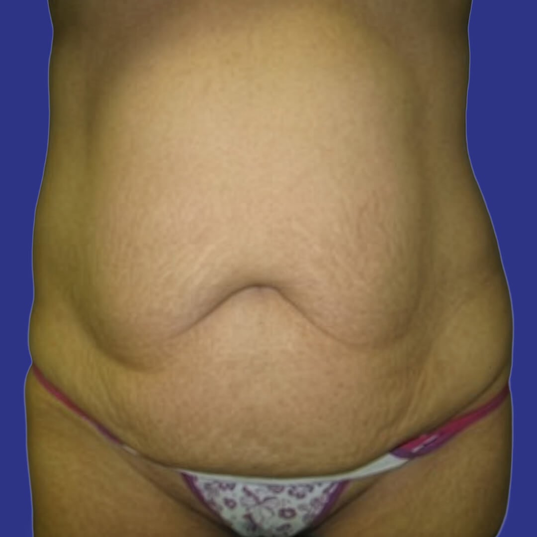 Procedure before and after - before