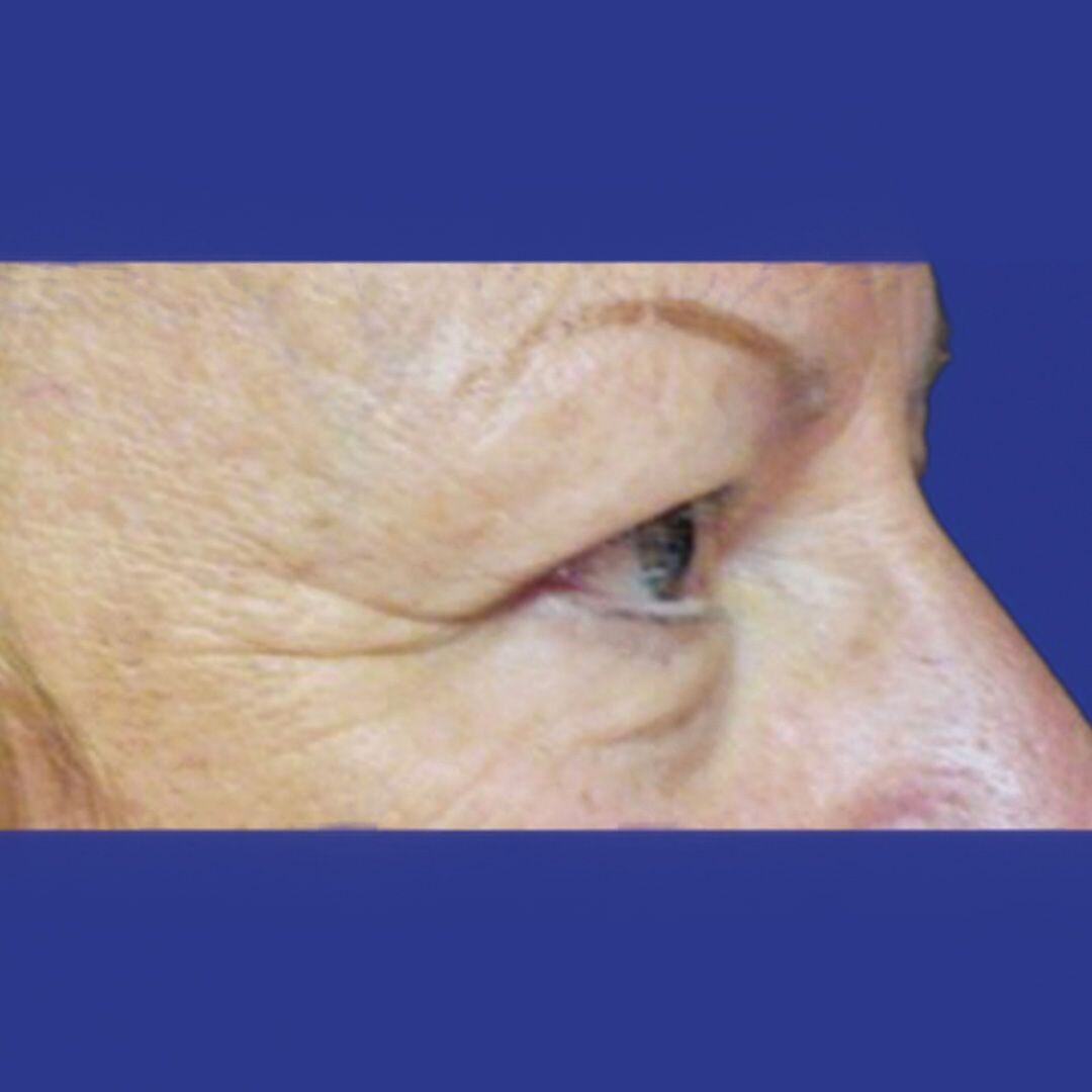 Procedure before and after - before