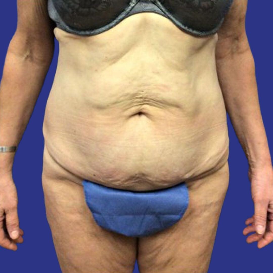 Procedure before and after - before