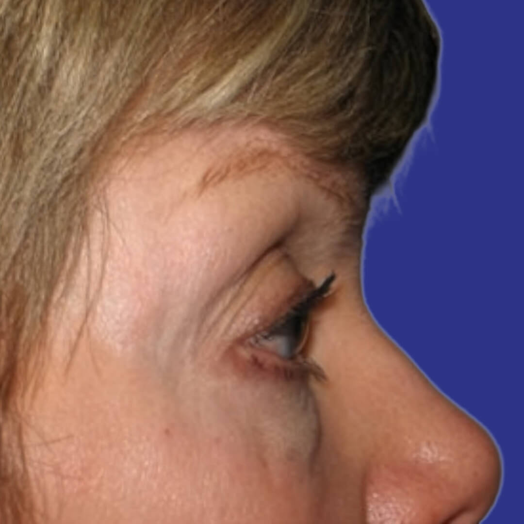 Procedure before and after - before