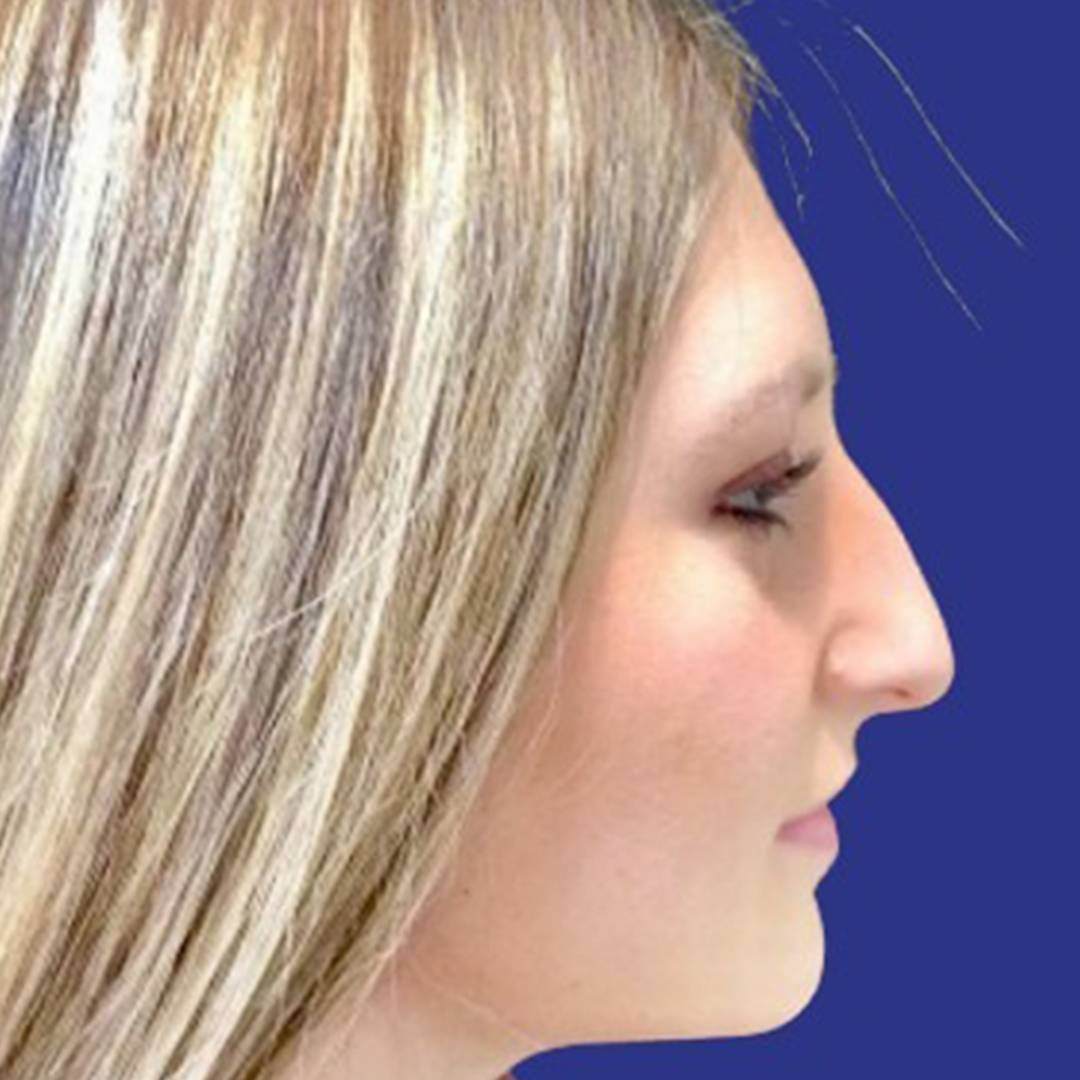 Procedure before and after - before