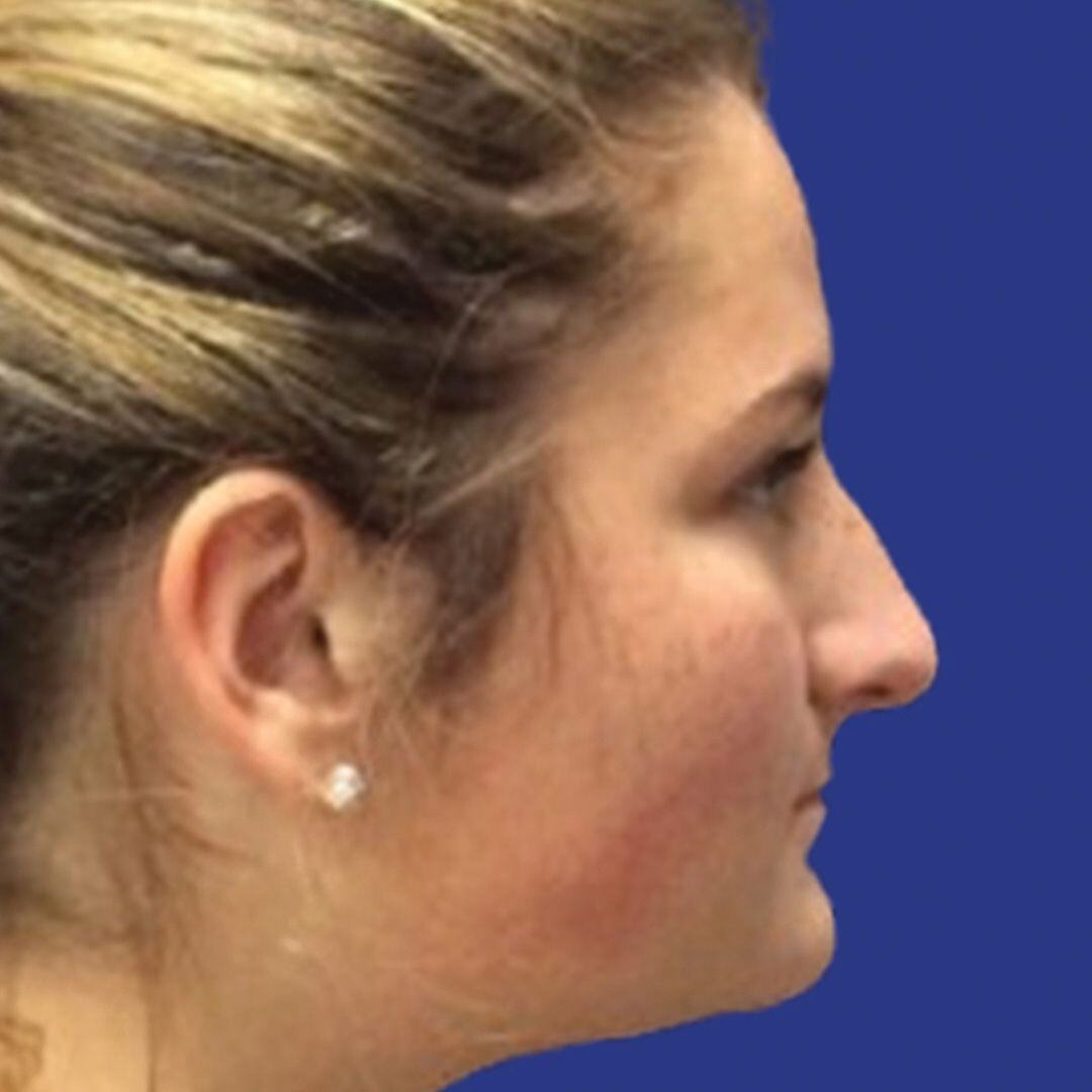 Procedure before and after - before
