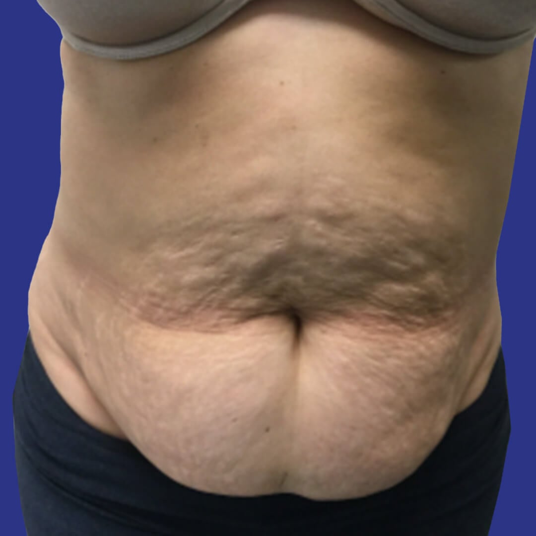 Procedure before and after - before