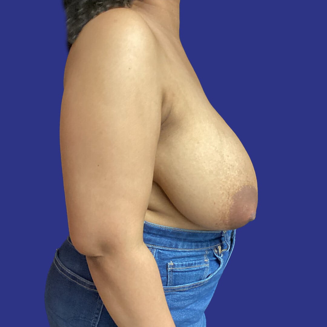 Procedure before and after - before