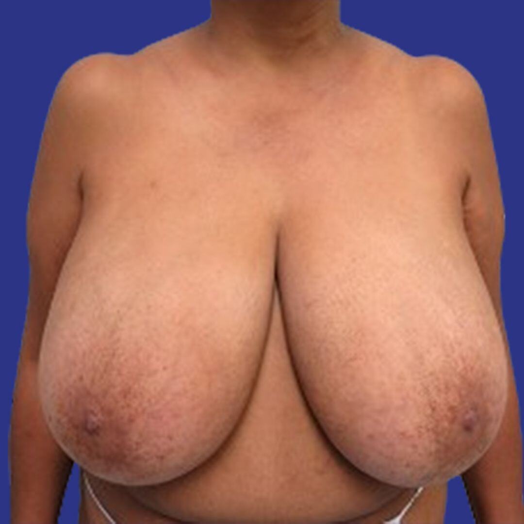 Procedure before and after - before