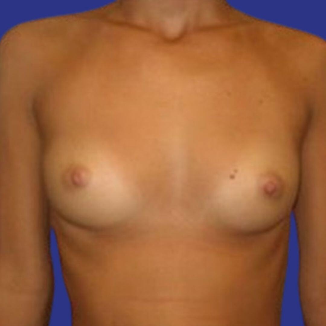 Procedure before and after - before