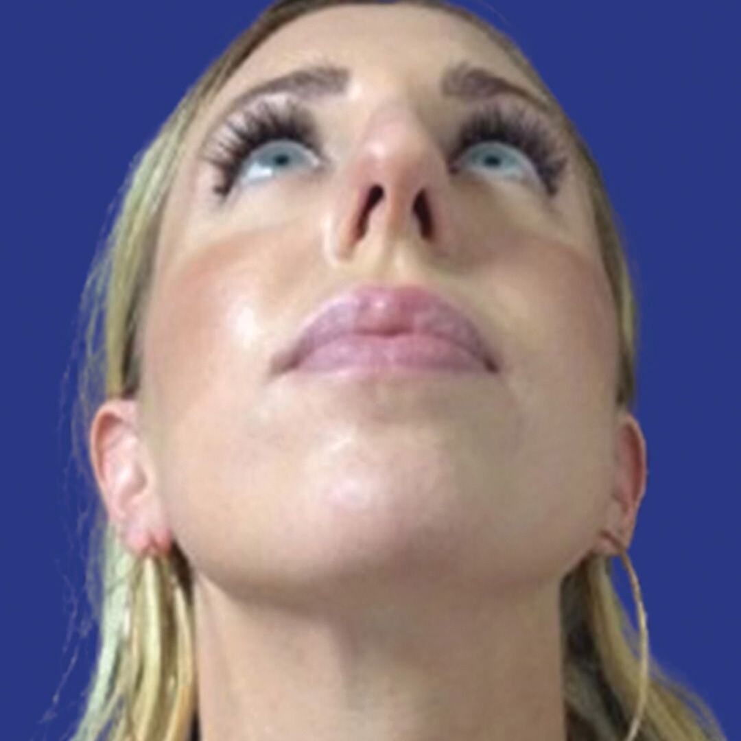Procedure before and after - before