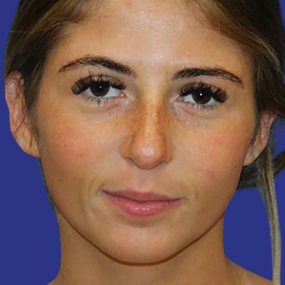 Procedure before and after - before