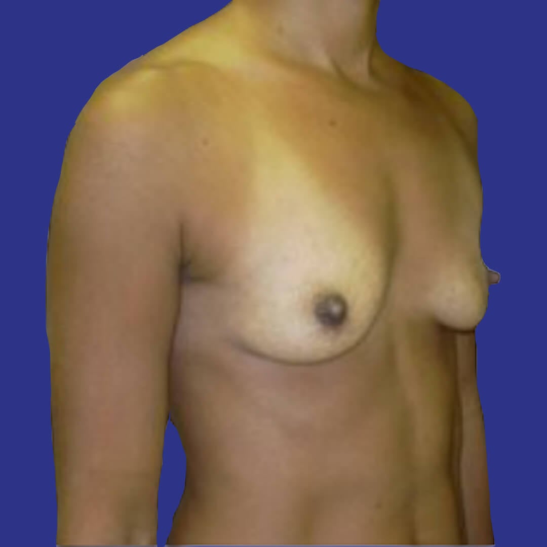 Procedure before and after - before