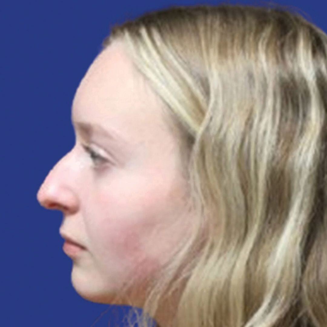Procedure before and after - before
