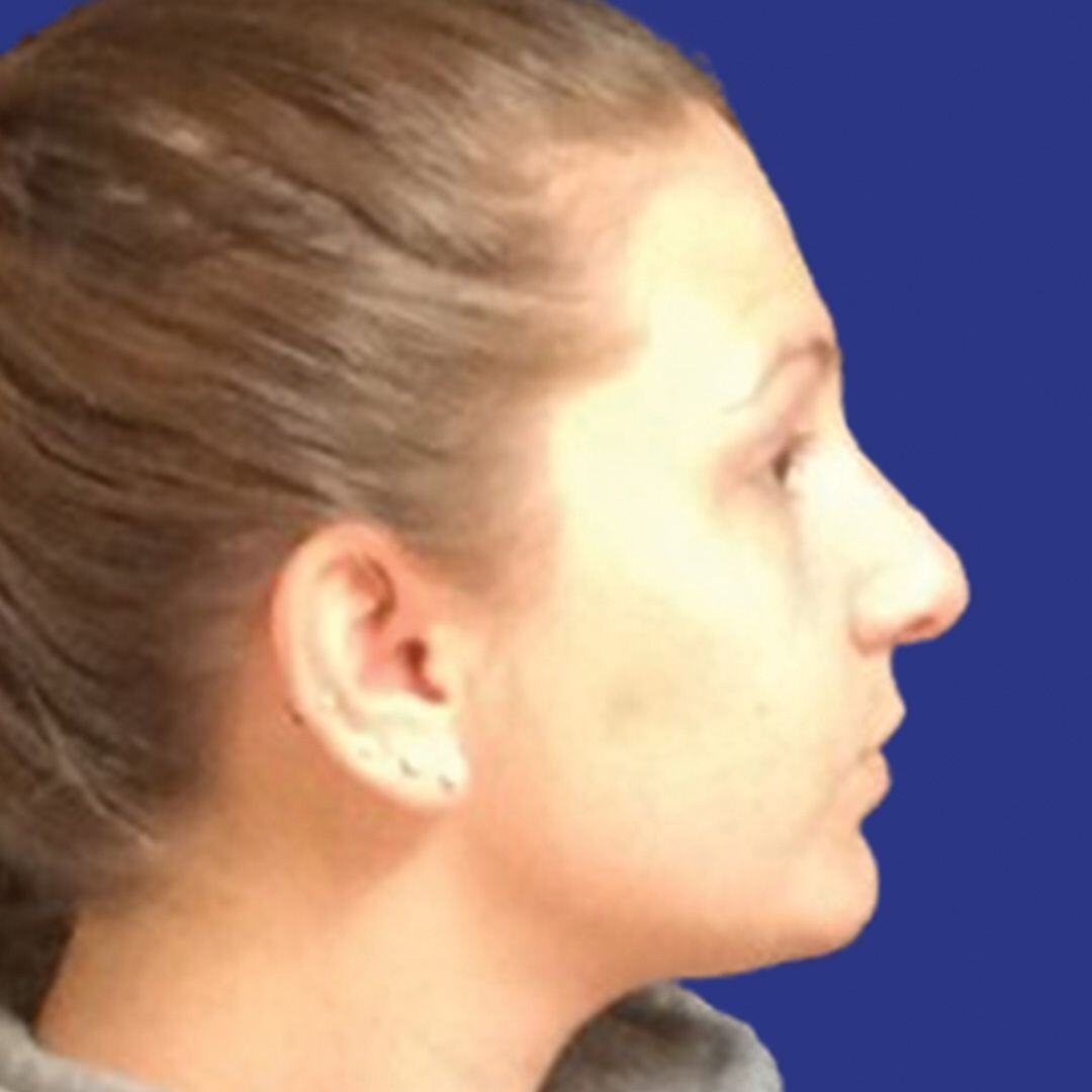 Procedure before and after - before