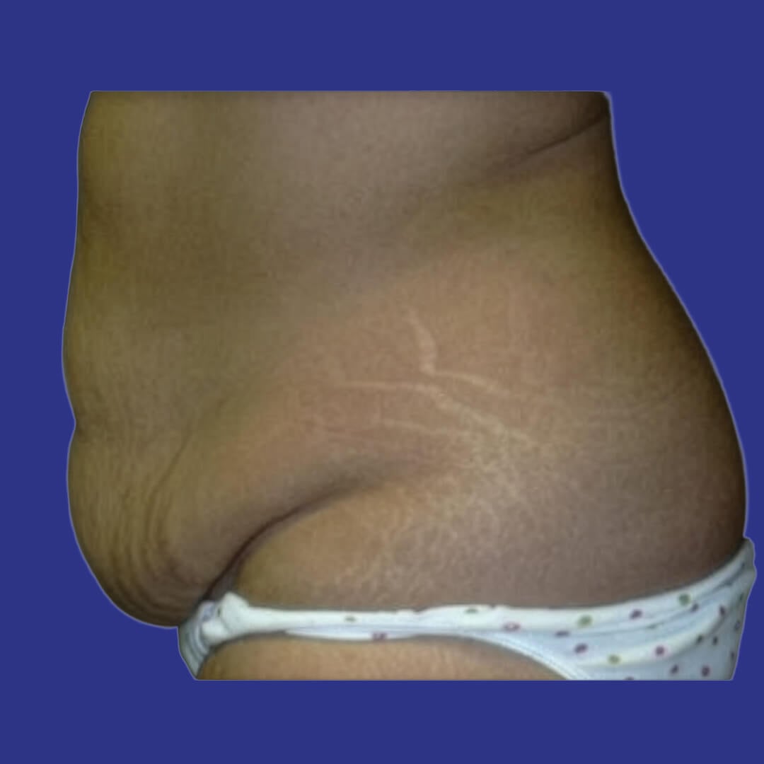 Procedure before and after - before