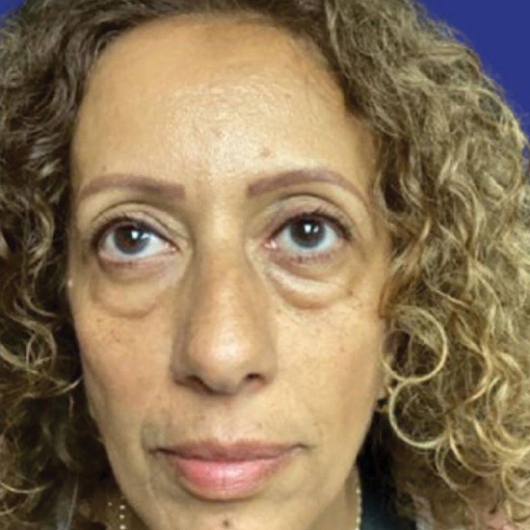 Procedure before and after - before