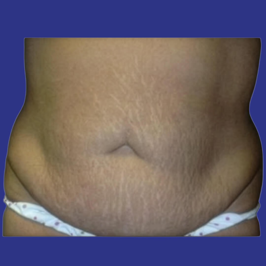 Procedure before and after - before