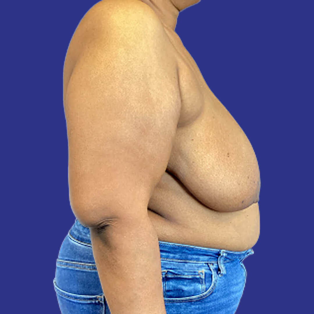 Procedure before and after - before