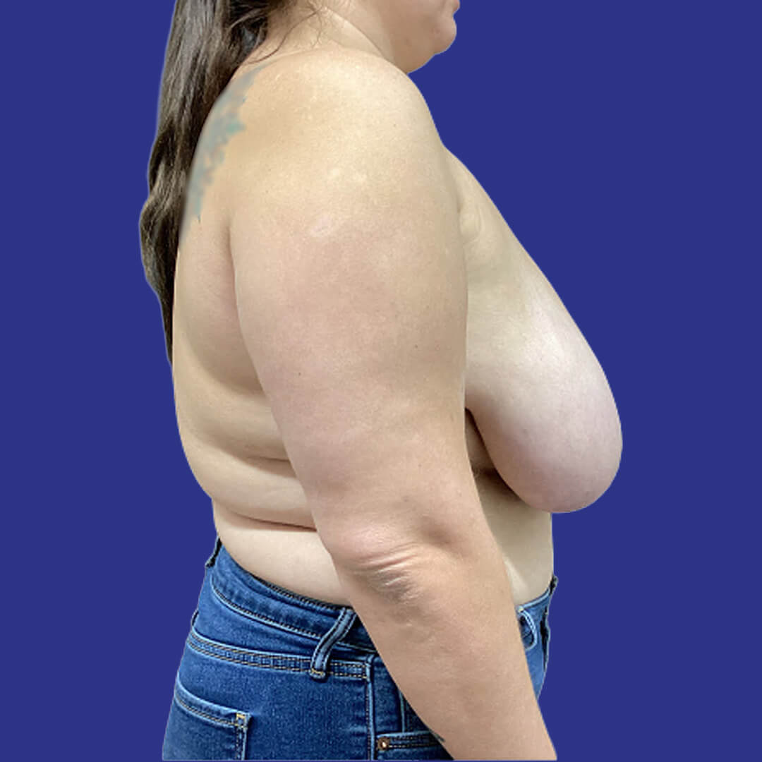 Procedure before and after - before