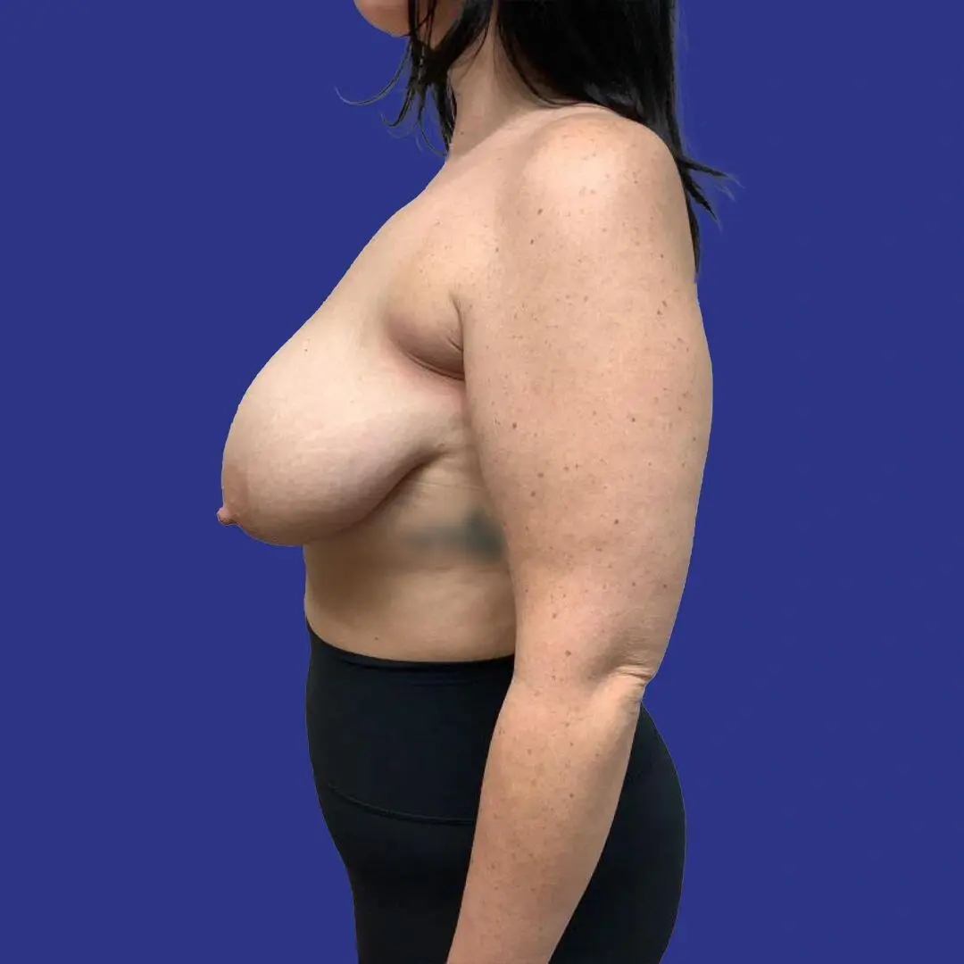 Procedure before and after - before
